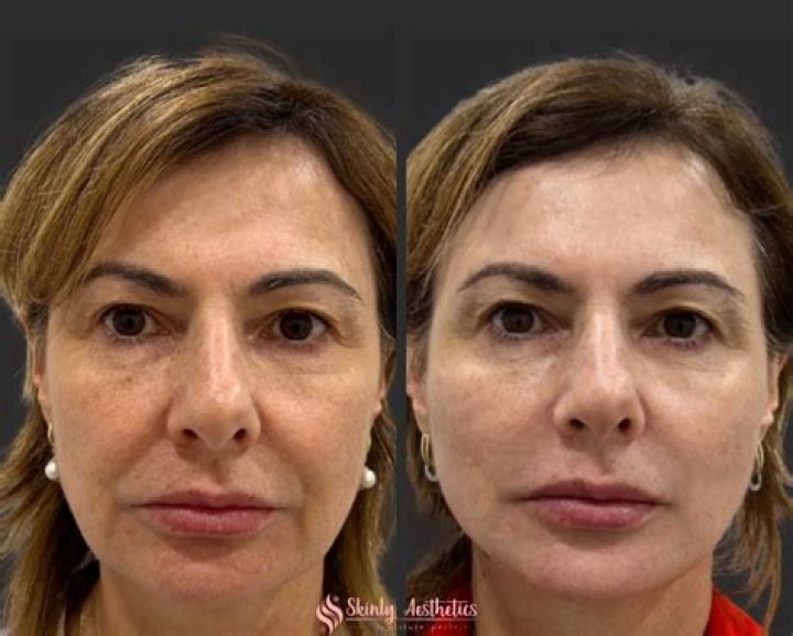 Gloria Borger's Facelift: Before And After Photos And Details